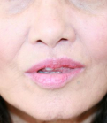 Feel Beautiful - Upper Lip Lift 215 - After Photo